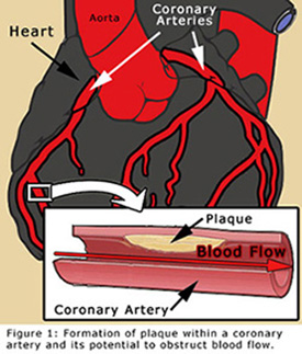 North Houston Coronary Angioplasty / Stent